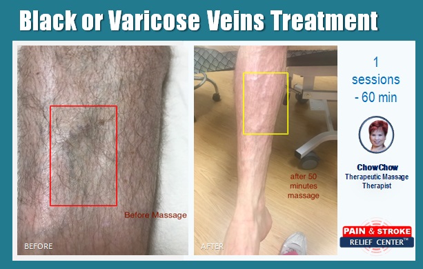 Black or Varicose Veins Treatment - pain and stroke relief center